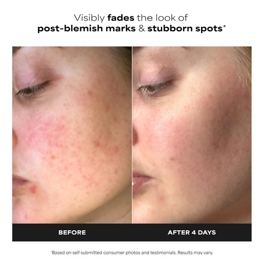 Paula's_Choice_BOOST_10%_Azelaic_Acid_Booster_Cream_Gel_Face_Serum_with_Salicylic_Acid,_Oil-Free_Skin_Brightening_Serum_for_Face,_Fragrance-Free