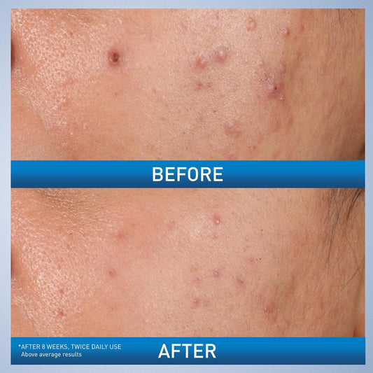 CeraVe_Acne_Control_Gel,_2%_Salicylic_Acid_Treatment_With_Glycolic_Acid_+_Lactic_Acids_+_Niacniamide,_Acne_Gel_Helps_Clear_Blemishes_Without_Over_Drying,_Alcohol_Free_&_Oil_Free,_1.35_Fl_Oz