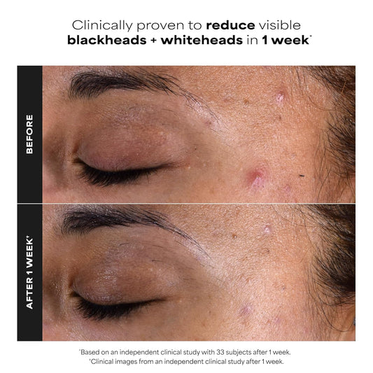 Paula's_Choice_SKIN_PERFECTING_2%_BHA_Salicylic_Acid_Exfoliating_Pads_-_Facial_Exfoliant_Pads_for_Blackheads,_Enlarged_Pores,_Wrinkles_&_Fine_Lines