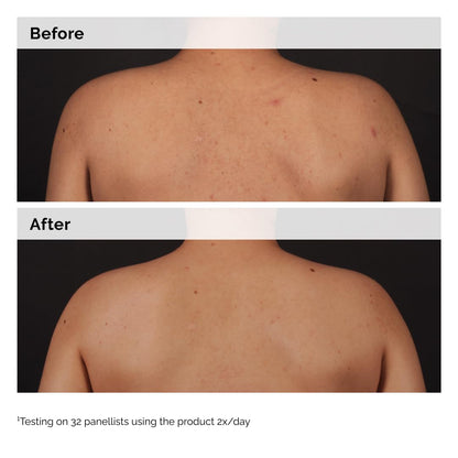 The_Ordinary_Salicylic_Acid_0.5%_Body_Serum,_Exfoliating_Treatment_for_Acne-Prone_Skin,_8.1_Fl_Oz