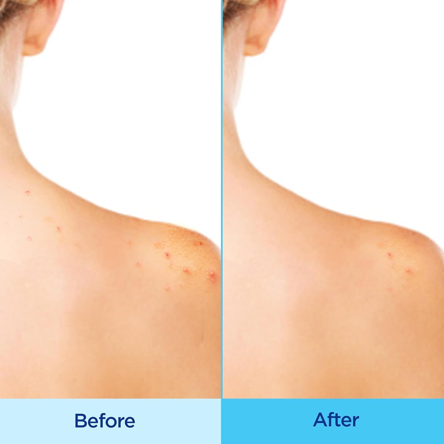 Differin_Acne_Body_Spray,_Acne_Treatment_with_Salicylic_Acid_by_the_makers_of_Differin_Gel,_360_Formula_for_Back_Acne,_Chest_and_Shoulders,_6_oz