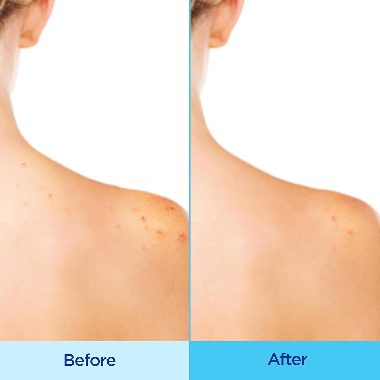 Differin_Acne_Body_Spray,_Acne_Treatment_with_Salicylic_Acid_by_the_makers_of_Differin_Gel,_360_Formula_for_Back_Acne,_Chest_and_Shoulders,_6_oz