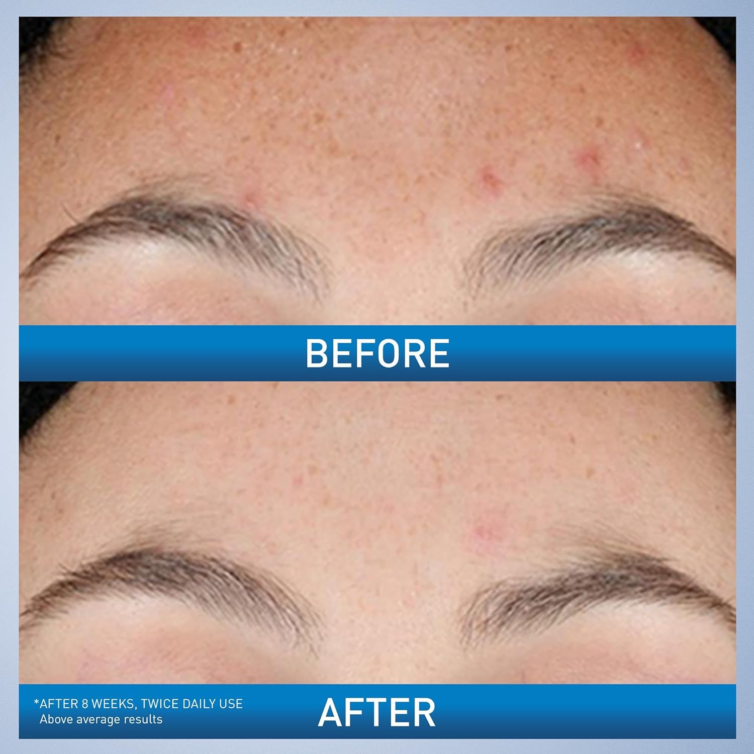 CeraVe_Resurfacing_Retinol_Serum_For_Post_Acne_Marks,_Formulated_With_Licorice_Root_Extract_&_Niacinamide,_Brightening_Serum_&_Pore_Minimizer_For_Face,_Post_Acne_Skin_Barrier_Repair,_Non-Comedogenic