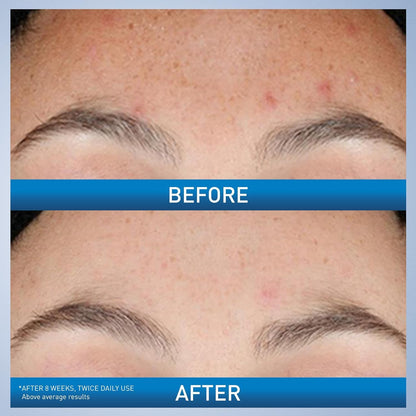 CeraVe_Resurfacing_Retinol_Serum_For_Post_Acne_Marks,_Formulated_With_Licorice_Root_Extract_&_Niacinamide,_Brightening_Serum_&_Pore_Minimizer_For_Face,_Post_Acne_Skin_Barrier_Repair,_Non-Comedogenic