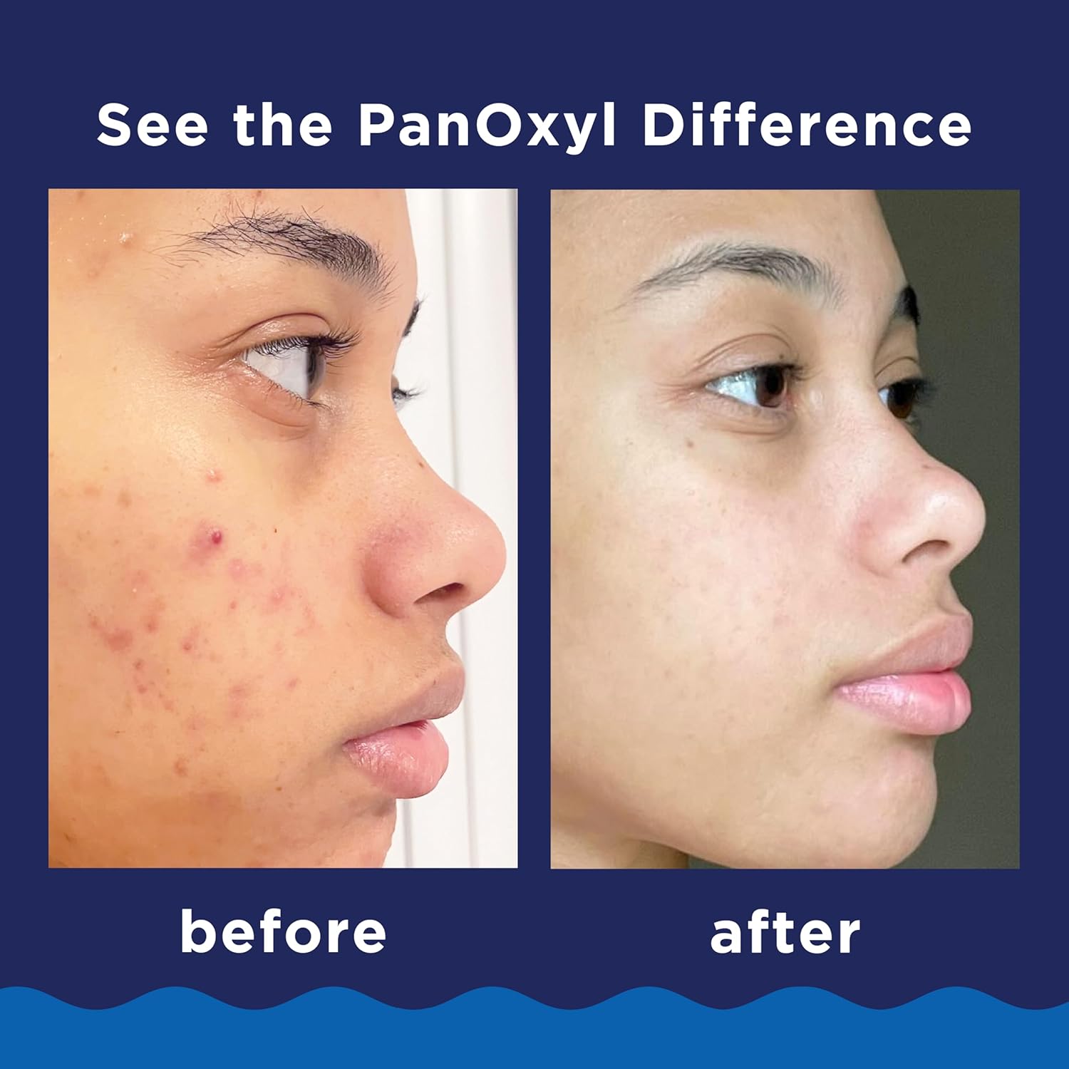 PanOxyl_10%_Benzoyl_Peroxide_Acne_Foaming_Wash,_Maximum_Strength,_Daily_Acne-Fighting_Face_and_Body_Cleanser,_Face_Wash_to_Clear,_Treat_and_Prevent_Acne_Pimples_and_Stubborn_Breakouts,_5.5_Oz_Tube