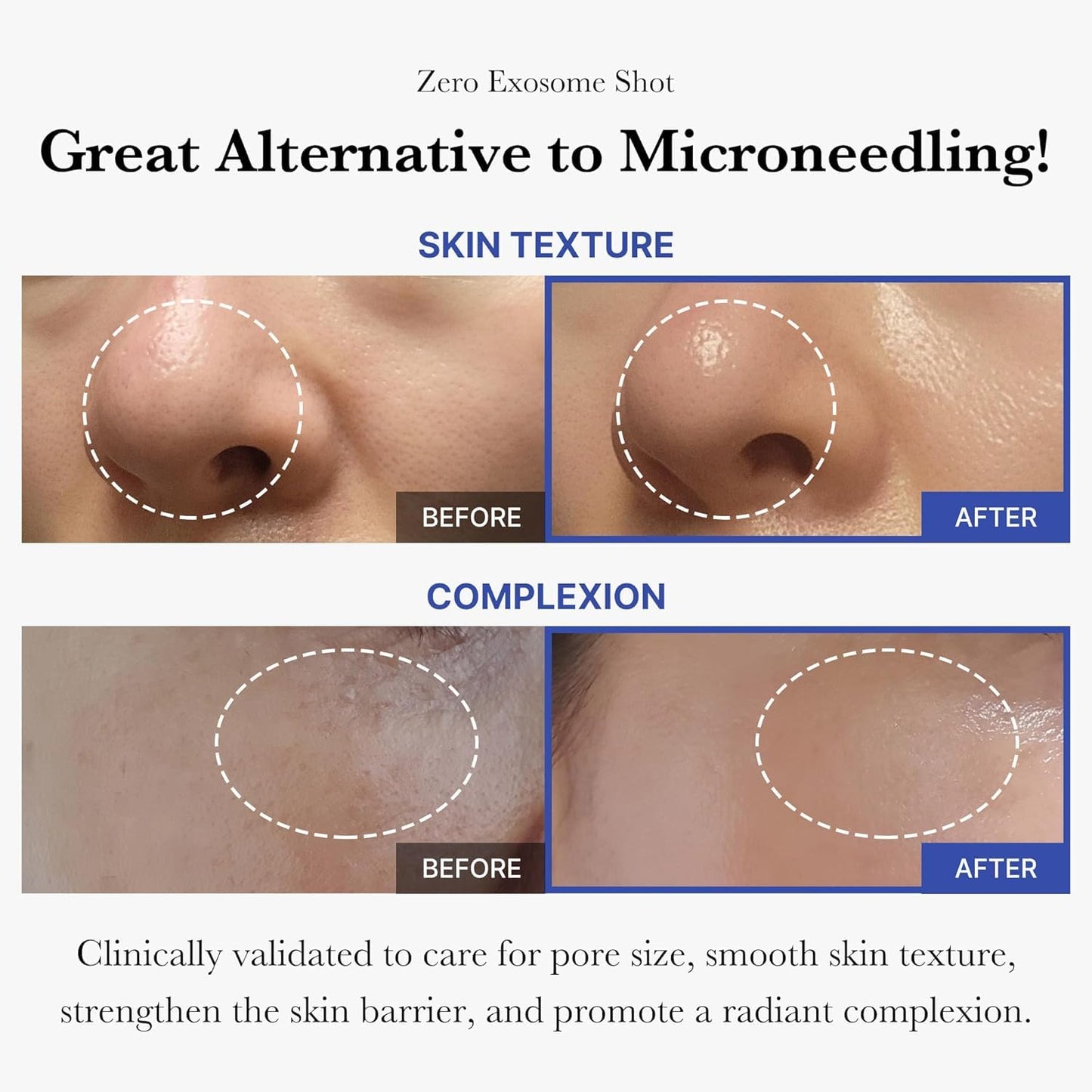 medicube_Exosome_Shot_Zero_2,000_PPM_Spicule_Facial_Serum_|_Liquid_Skin_Booster_Serum_|_Exosome,_AHA+BHA+PHA_|_Pore_Care,_Dead_Skin_Cells,_Skin_Texture_|_Korean_Skincare,_1.01_fl.oz