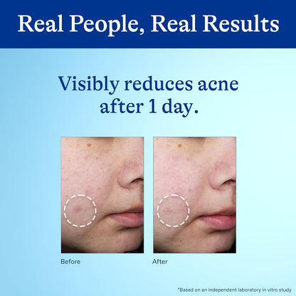 Differin_Acne_Spot_Treatment_with_10%_Benzoyl_Peroxide,_Maximum_Strength_OTC_Acne_Treatment,_Fast_Acting_Spot_Treatment_for_Face,_1_oz