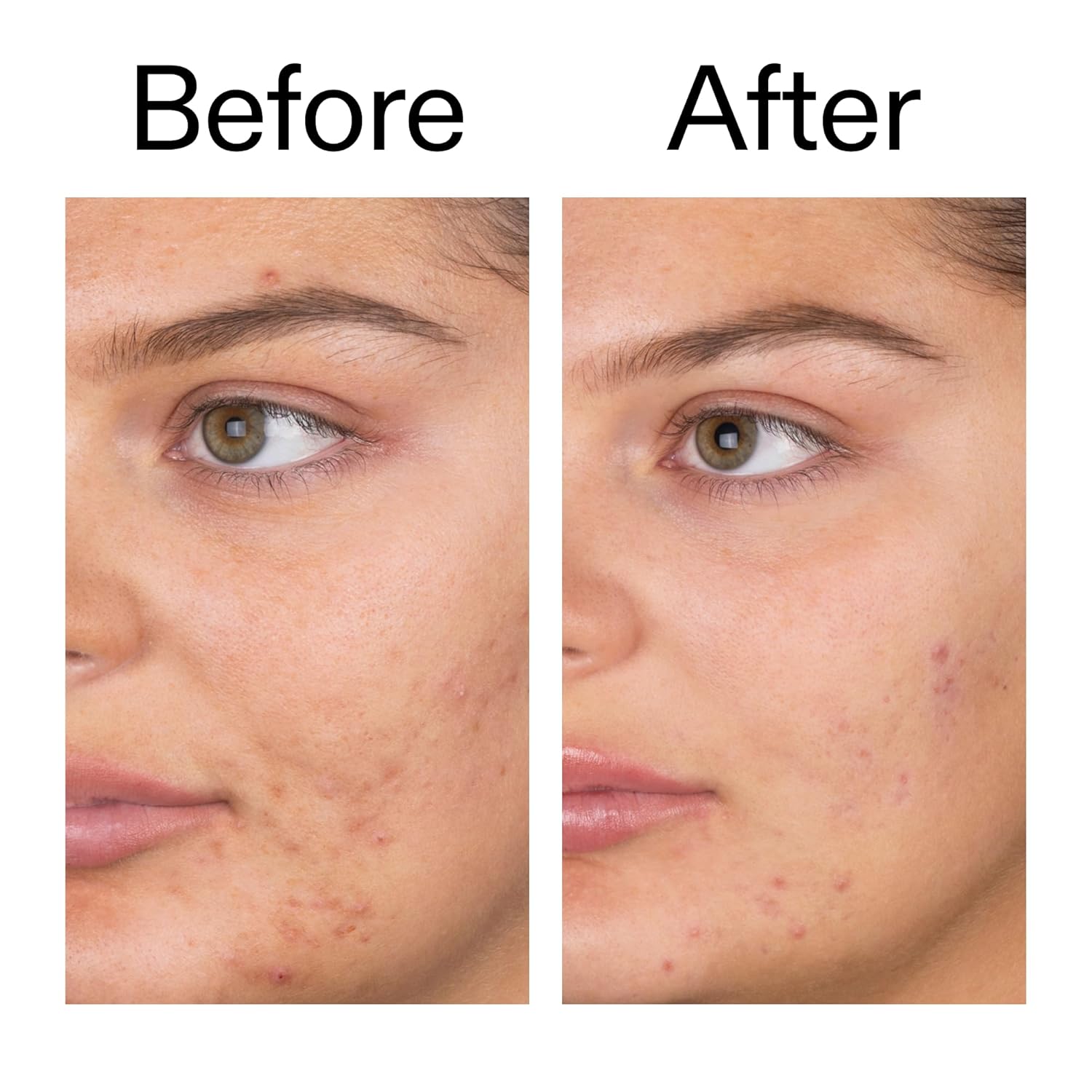 The_INKEY_List_Salicylic_Acid_Cleanser_-_Daily_Exfoliating_Cleanser_with_2%_Salicylic_Acid_&_Zinc_PCA,_Unclogs_Pores,_Anti_Acne,_Reduces_Blackheads_&_Excess_Oil_for_Clearer_Skin