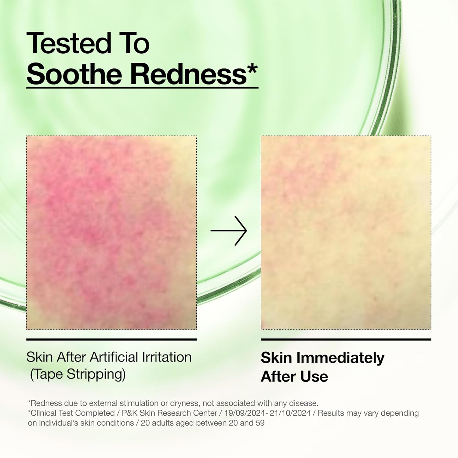 Anua_Azelaic_Acid_10_Hyaluron_Redness_Soothing_Serum,_Facial_Serum_for_Blemish-Prone_&_Oily-Prone_Skin,_Lightweight_&_Hydrating_Blemish_Care,_Hyaluronic_Acid,_Korean_Skincare,_1.01_fl_oz.
