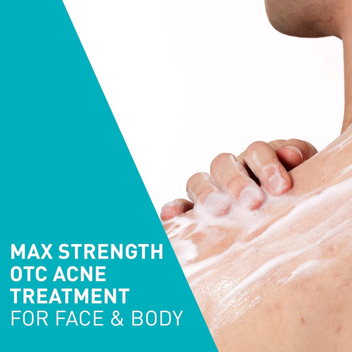 CeraVe_Acne_Foaming_Cream_Wash,_Gentle_Face_and_Body_Cleanser_with_Benzoyl_Peroxide_10%,_Hyaluronic_Acid,_and_Niacinamide,_10%_Benzoyl_Peroxide_Treatment_Clears_Pimples_and_Blackheads_5_Oz