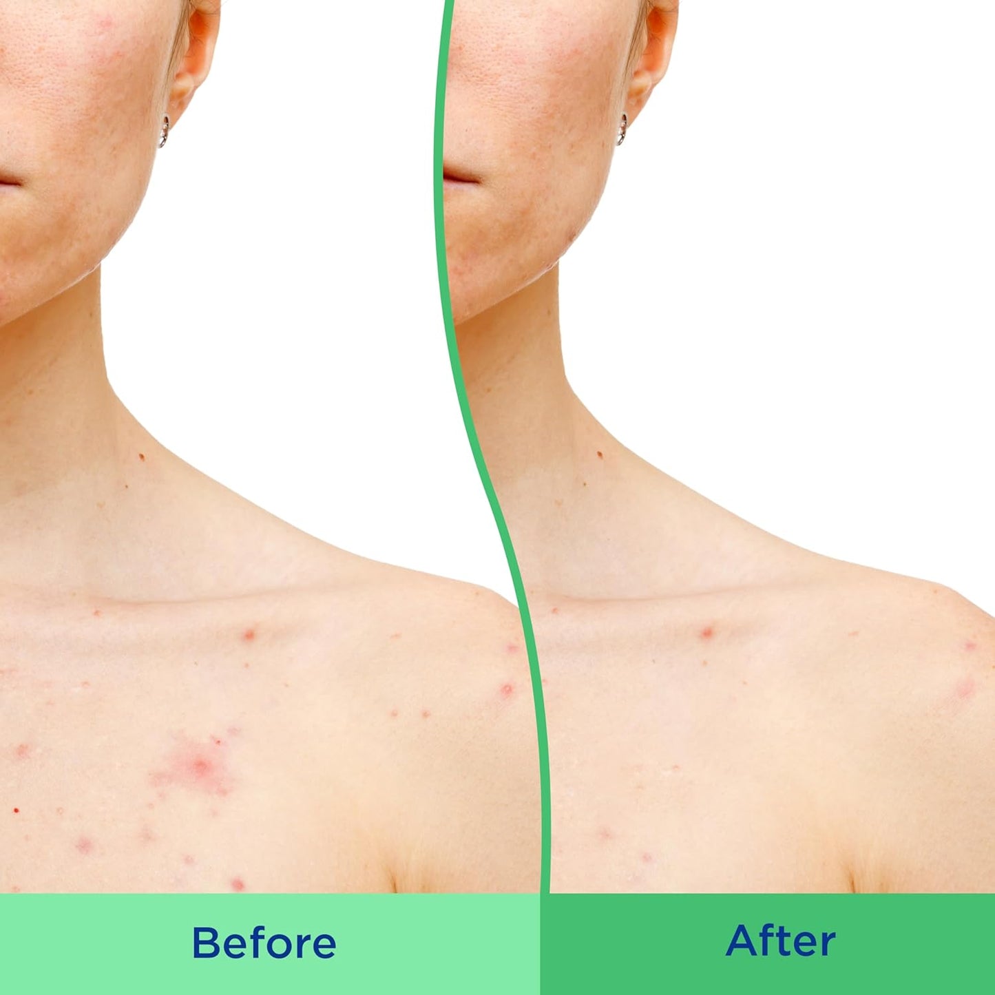 Differin_Body_Scrub_with_Salicylic_Acid_Acne_Clearing_Improves_Tone_and_Texture_Prone_Skin_on_Back_Shoulders_and_Chest,_8_Oz_(Packaging_May_Vary)