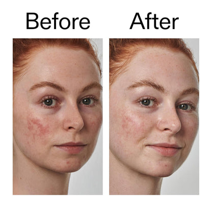 The_INKEY_List_SuperSolutions_Azelaic_Acid_10%_Serum,_Fast-Absorbing_Formula_Helps_Reduce_Appearance_of_Redness_and_Soothes_Skin,_Leaves_No_White_Cast,_1.01_fl_oz