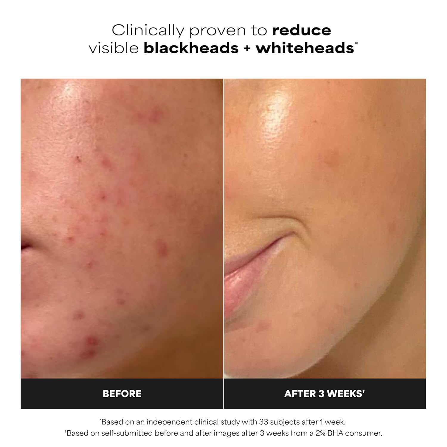 Paula's_Choice_SKIN_PERFECTING_2%_BHA_Salicylic_Acid_Exfoliating_Pads_-_Facial_Exfoliant_Pads_for_Blackheads,_Enlarged_Pores,_Wrinkles_&_Fine_Lines