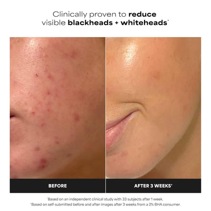 Paula's_Choice_SKIN_PERFECTING_2%_BHA_Salicylic_Acid_Exfoliating_Pads_-_Facial_Exfoliant_Pads_for_Blackheads,_Enlarged_Pores,_Wrinkles_&_Fine_Lines