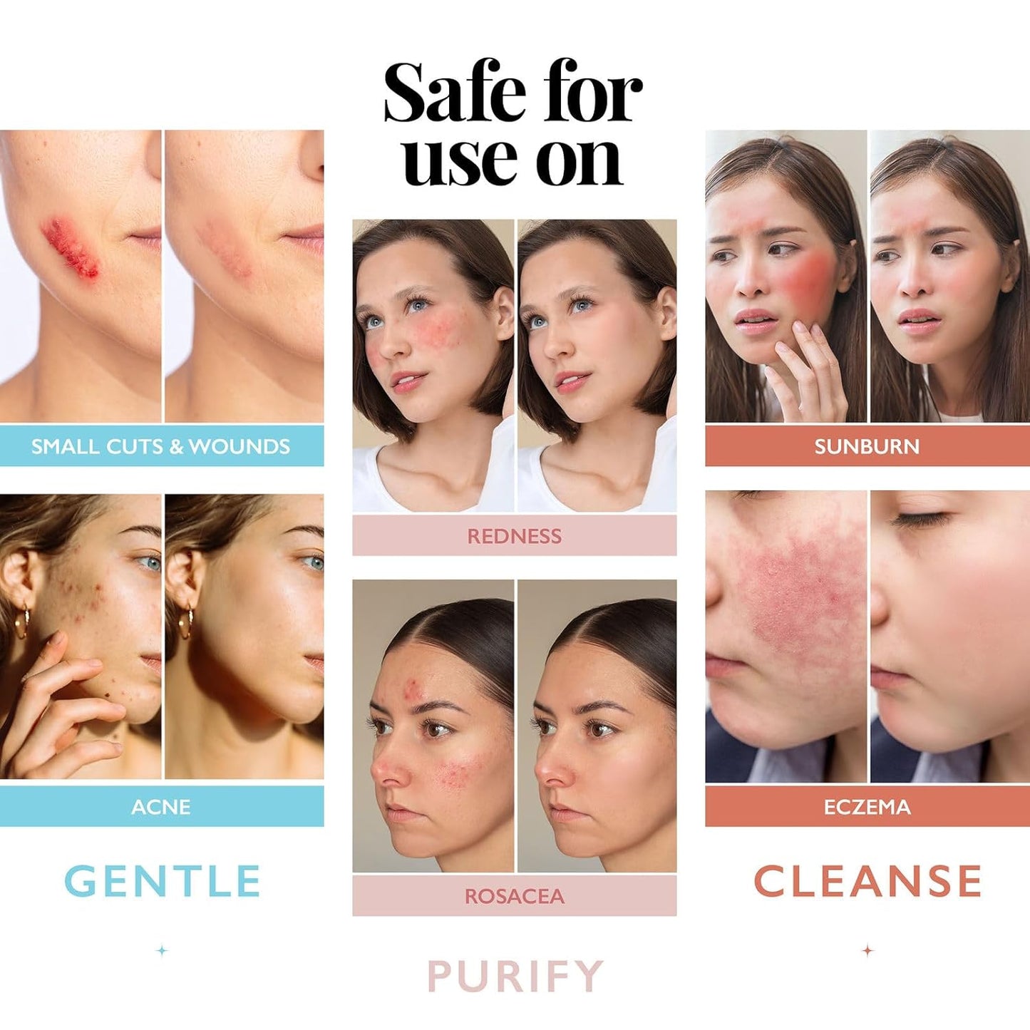 Hypochlorous_Acid_Spray_for_Face_and_Skin;_Facial_Cleanser_|_8oz_Face_Mist_Hypochlorous_Acid_Spray_for_Skin,_Acne,_Rash,_Eczema,_Wound_|_Antimicrobial_Facial_Cleanser_Acne_Sprays;_Smart_Skincare