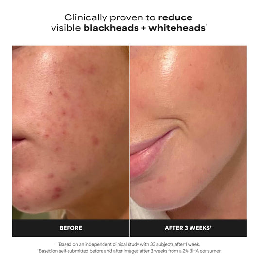 Paula's_Choice_SKIN_PERFECTING_2%_BHA_Liquid_Exfoliant_with_Salicylic_Acid,_Facial_Polish_for_Pores,_Wrinkles_&_Fine_Lines,_Suitable_for_Blackhead-Prone_Skin,_Fragrance-Free
