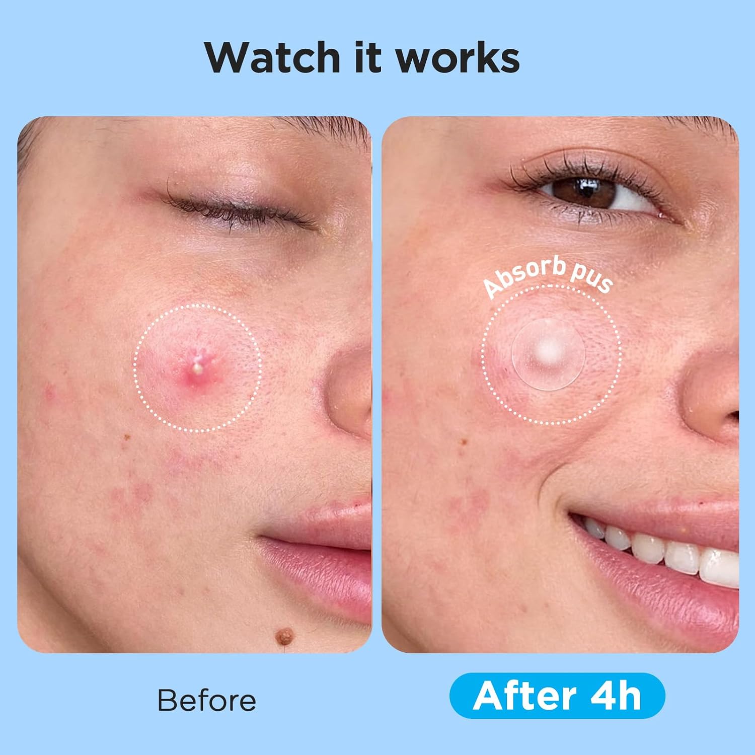 Pimple_Patches_for_Face_(504_Count),_FSA_Eligible_Acne_Patch_Bulk,_Zit_Stickers_4_Sizes,_Hydrocolloid_Spot_Stickers,_Clear_Acne_Dots_for_Covering_Zits,_Blemishes_and_Breakouts
