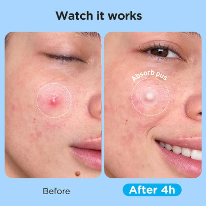 Pimple_Patches_for_Face_(504_Count),_FSA_Eligible_Acne_Patch_Bulk,_Zit_Stickers_4_Sizes,_Hydrocolloid_Spot_Stickers,_Clear_Acne_Dots_for_Covering_Zits,_Blemishes_and_Breakouts