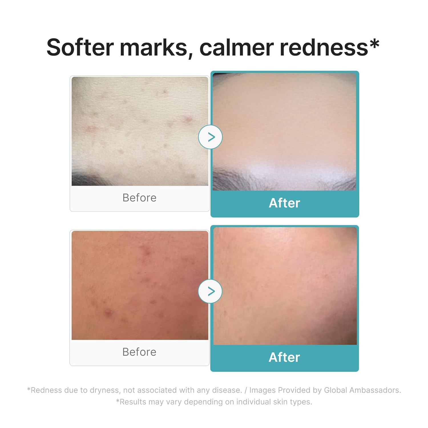 medicube_Azelaic_Acid_10_Soothing_Serum_|_Clarifying_Serum_for_Troubled_&_Oily-Prone_Skin_with_B3+B5_|_Stressed_Skin_Calming_&_Post-Blemish_Tone_Care_|_Korean_Skincare_30ml,_1.01_fl_oz
