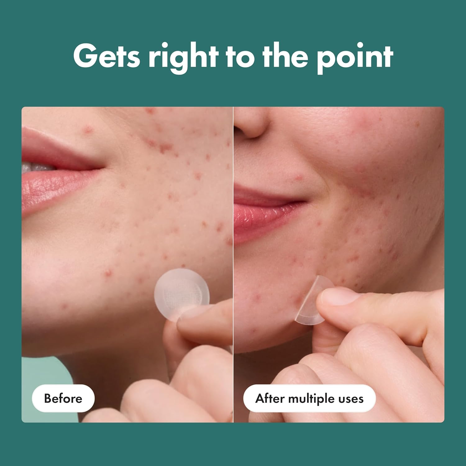 Mighty_Patch_Hero_Cosmetics_Micropoint_Acne_Pimple_Patches,_8_Ct_|_For_Early_Stage_Zits_&_Hidden_Blemishes;_Hydrocolloid_with_Salicylic_Acid,_Niacinamide,_Cica;_395_Micropoints;_Acne_Stickers
