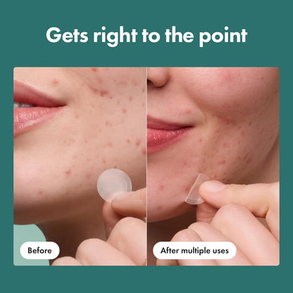 Mighty_Patch_Hero_Cosmetics_Micropoint_Acne_Pimple_Patches,_8_Ct_|_For_Early_Stage_Zits_&_Hidden_Blemishes;_Hydrocolloid_with_Salicylic_Acid,_Niacinamide,_Cica;_395_Micropoints;_Acne_Stickers