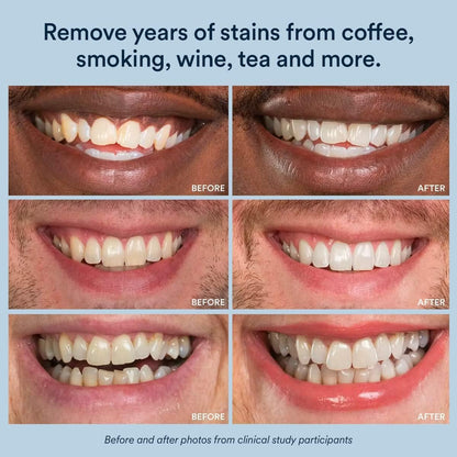 Sensitive_Teeth_Whitening_Strips_–_14_Treatments_(28_Strips),_8%_Hydrogen_Peroxide_with_Nano_Hydroxyapatite,_Low_Sensitivity_At-Home_Whitening,_Mint_–_Auraglow