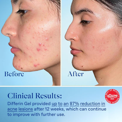 Differin_Acne_Treatment_Gel,_90_Day_Supply,_Retinoid_Treatment_for_Face_with_0.1%_Adapalene,_Gentle_Skin_Care_for_Acne_Prone_Sensitive_Skin,_45g_Pump_(Packaging_May_Vary)