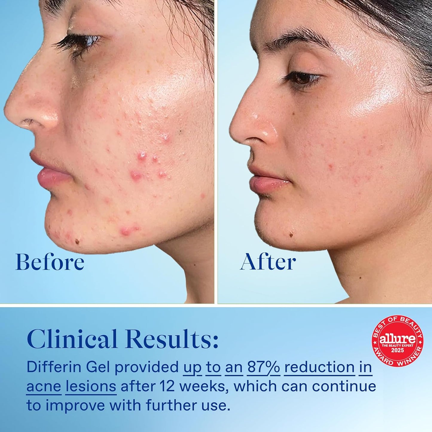 Differin_Acne_Treatment_Gel,_30_Day_Supply,_Retinoid_Treatment_for_Face_with_0.1%_Adapalene,_Gentle_Skin_Care_for_Acne_Prone_Sensitive_Skin,_15g_Pump_(Packaging_May_Vary)