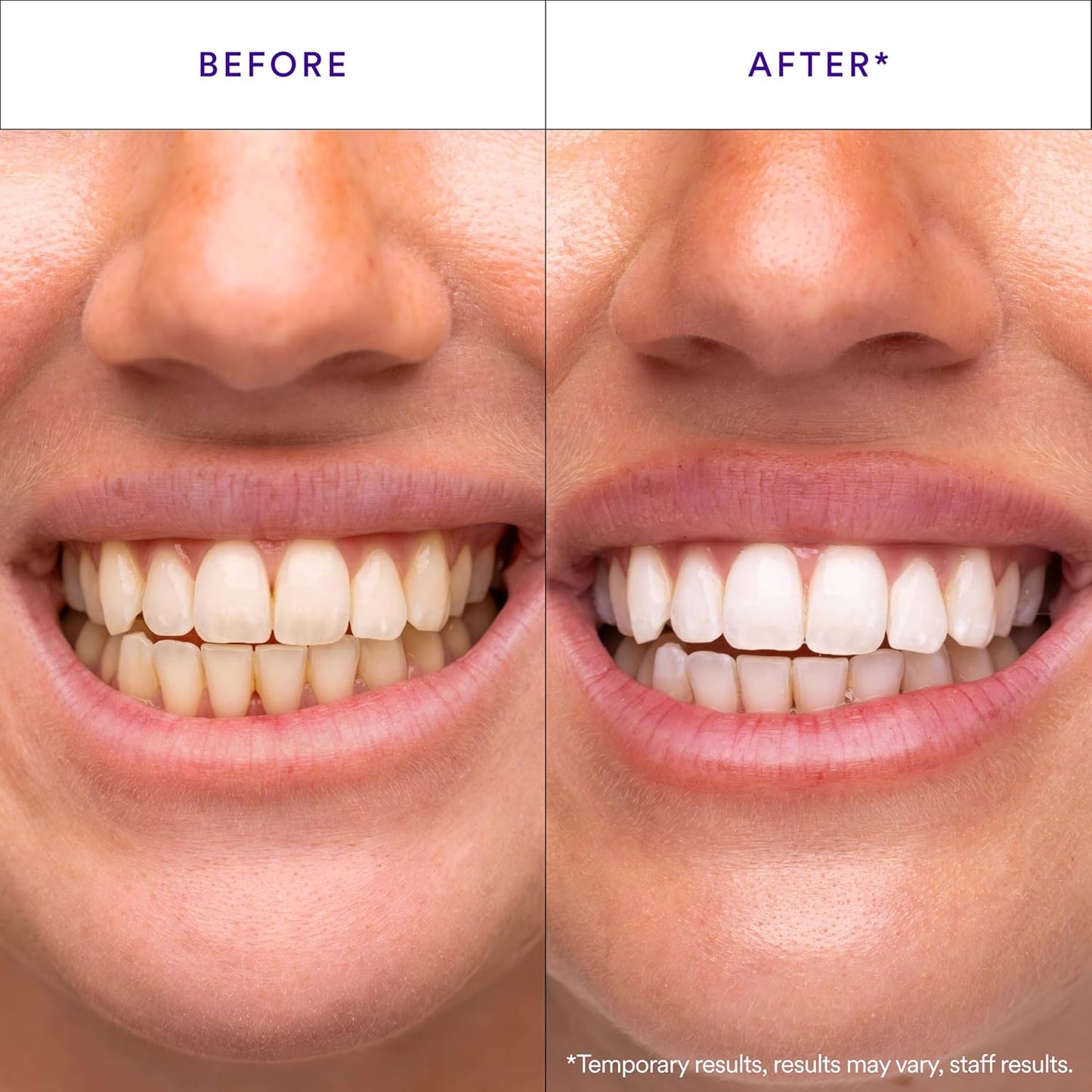Hismile_V34_Whitening_Strips,_Teeth_Whitening_Strips,_Purple_Tooth_Whitening,_Purple_V34_Whitening_Strips,_Tooth_Stain_Treatment,_Combining_Whitening_and_Colour_Correction