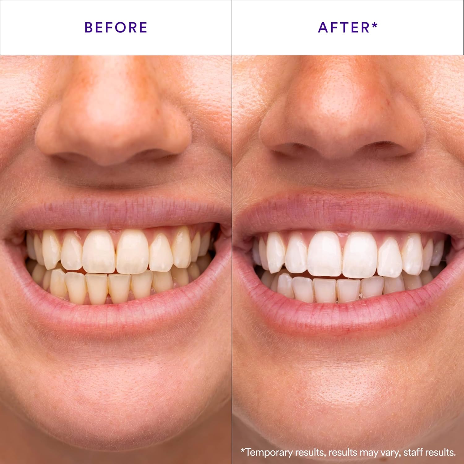 Hismile_V34_Whitening_Strips,_Teeth_Whitening_Strips,_Purple_Tooth_Whitening,_Purple_V34_Whitening_Strips,_Tooth_Stain_Treatment,_Combining_Whitening_and_Colour_Correction
