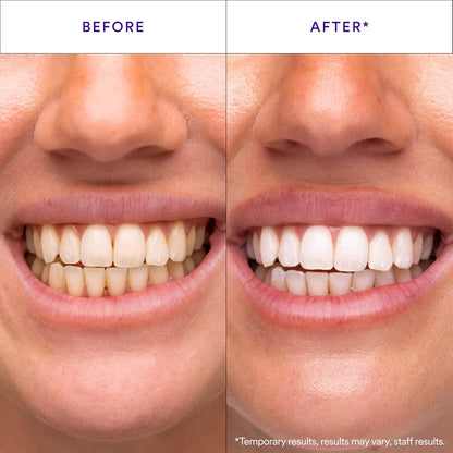 Hismile_V34_Whitening_Strips,_Teeth_Whitening_Strips,_Purple_Tooth_Whitening,_Purple_V34_Whitening_Strips,_Tooth_Stain_Treatment,_Combining_Whitening_and_Colour_Correction