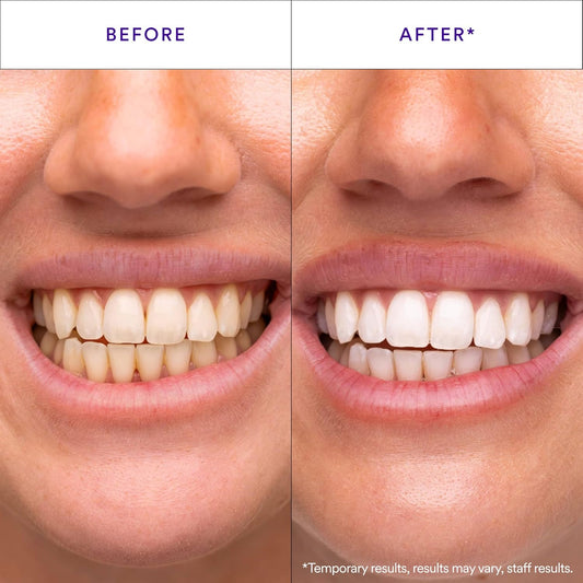Hismile_V34_Whitening_Strips,_Teeth_Whitening_Strips,_Purple_Tooth_Whitening,_Purple_V34_Whitening_Strips,_Tooth_Stain_Treatment,_Combining_Whitening_and_Colour_Correction