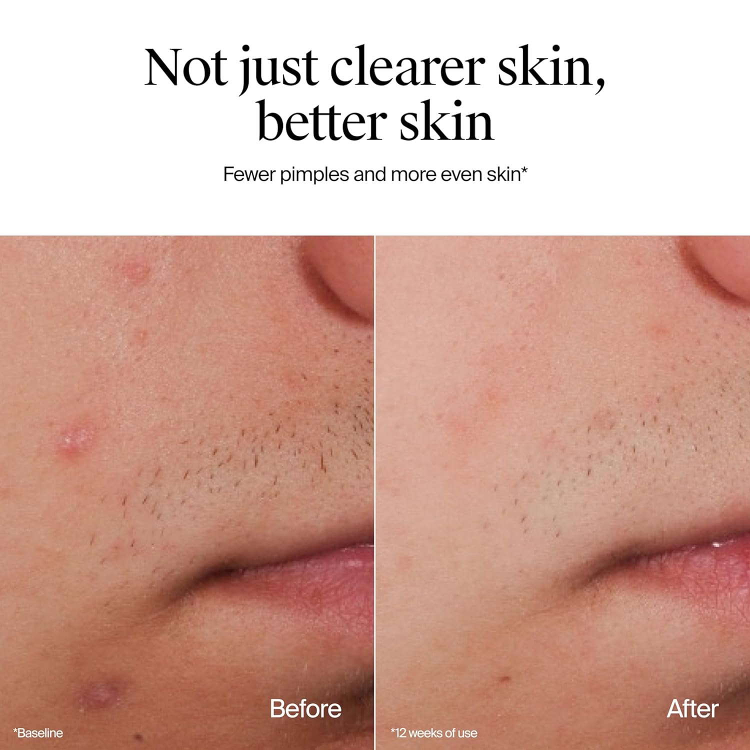 Neutrogena_Oil-Free_Acne_Face_Wash,_Fragrance_Free,_Sensitive_Skin_Facial_Cleanser_with_2%_Salicylic_Acid_Acne_Treatment_for_Face,_9.1_Fl_Oz