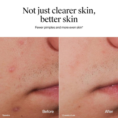Neutrogena_Oil-Free_Acne_Face_Wash,_Fragrance_Free,_Sensitive_Skin_Facial_Cleanser_with_2%_Salicylic_Acid_Acne_Treatment_for_Face,_9.1_Fl_Oz
