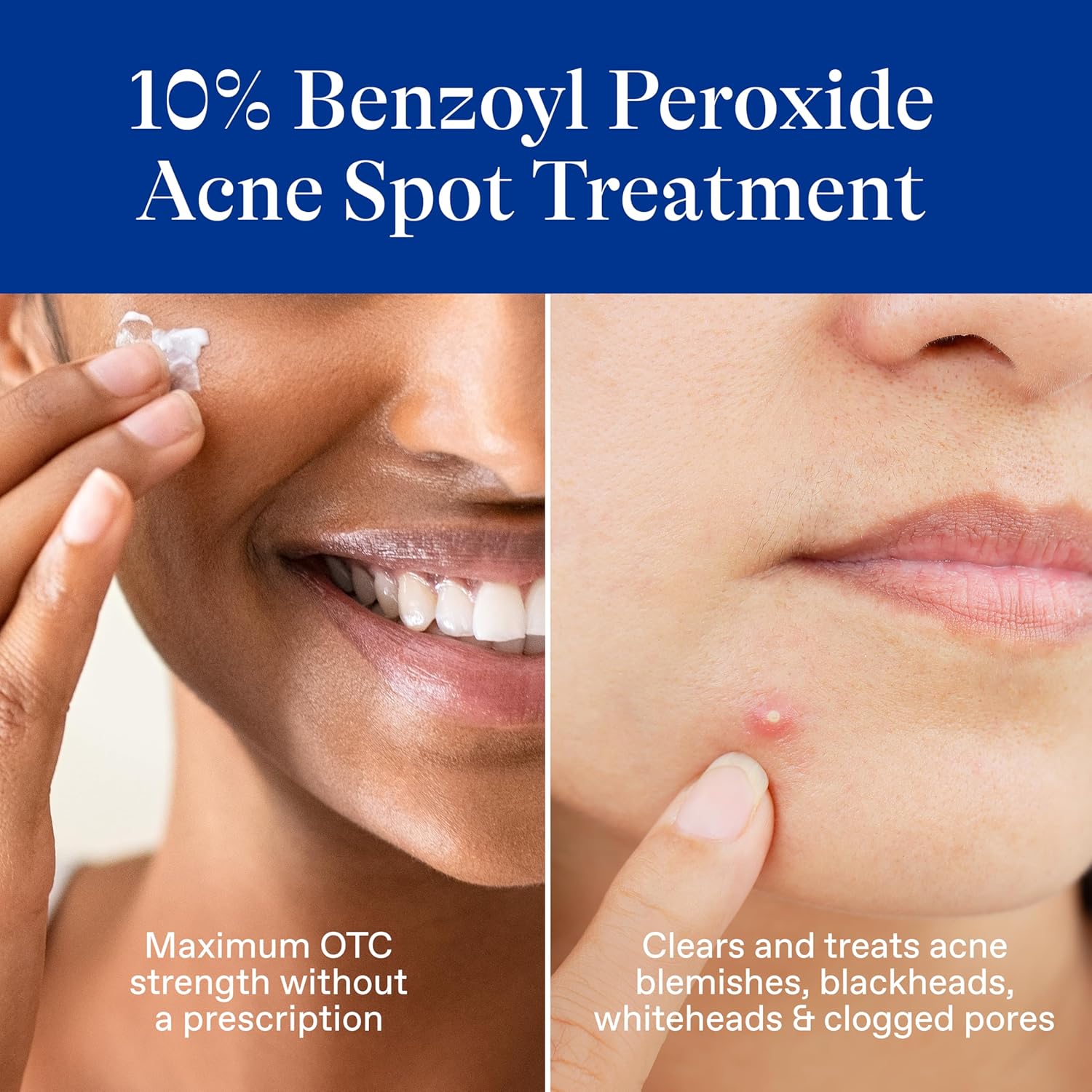 Differin_Acne_Spot_Treatment_with_10%_Benzoyl_Peroxide,_Maximum_Strength_OTC_Acne_Treatment,_Fast_Acting_Spot_Treatment_for_Face,_1_oz