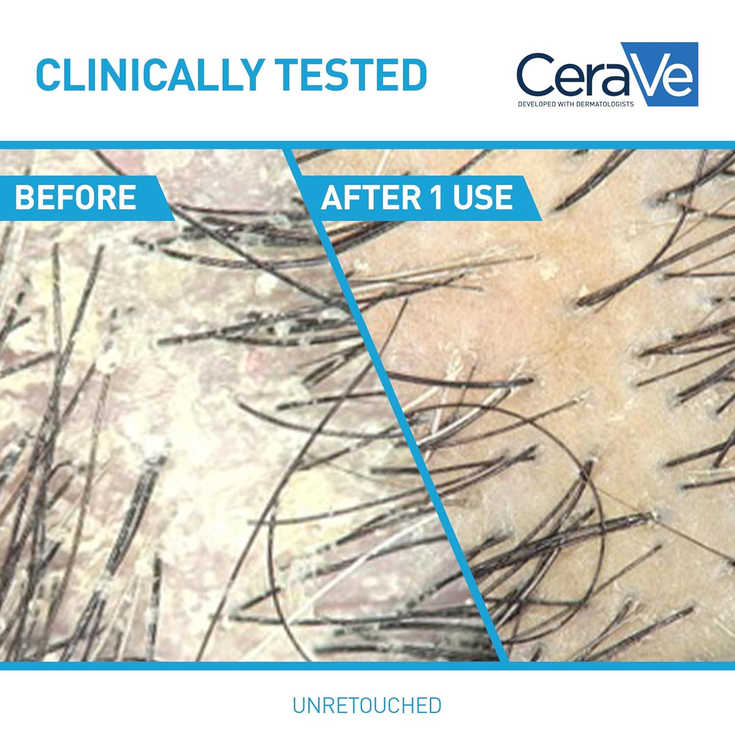 CeraVe_Hydrating_Anti_Dandruff_Shampoo,_1%_Pyrithione_Zinc_Dandruff_Treatment_With_Ceramides,_Niacinamide_&_Hyaluronic_Acid,_Helps_Eliminate_Flakes_&_Provides_Itchy_Scalp_Relief,_Sulfate_Free,_19_Oz