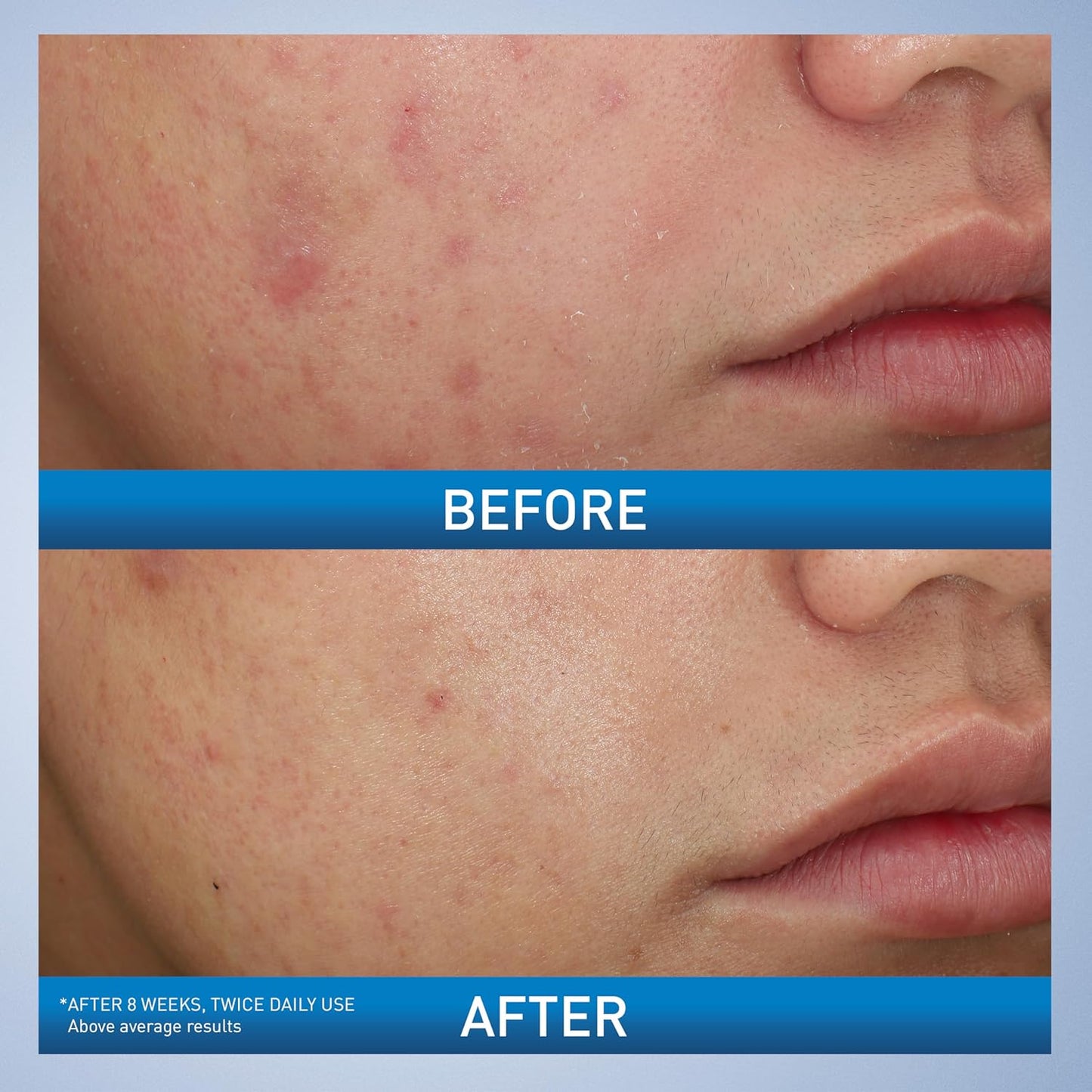 CeraVe_Acne_Foaming_Cream_Wash,_Gentle_Face_and_Body_Cleanser_with_Benzoyl_Peroxide_10%,_Hyaluronic_Acid,_and_Niacinamide,_10%_Benzoyl_Peroxide_Treatment_Clears_Pimples_and_Blackheads_5_Oz