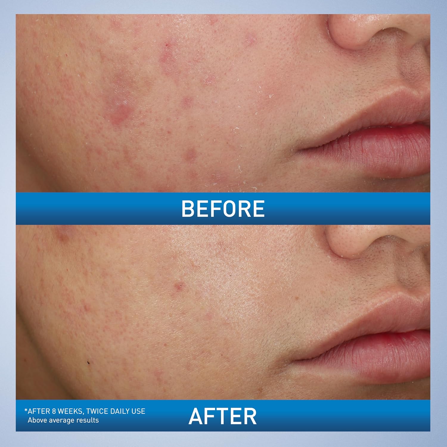 CeraVe_Acne_Foaming_Cream_Wash,_Gentle_Face_and_Body_Cleanser_with_Benzoyl_Peroxide_10%,_Hyaluronic_Acid,_and_Niacinamide,_10%_Benzoyl_Peroxide_Treatment_Clears_Pimples_and_Blackheads_5_Oz