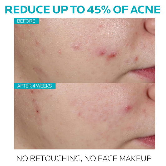 La_Roche-Posay_Effaclar_1.5%_Salicylic_Acid_Serum,_Acne_Treatment_For_Face_With_Glycolic_Acid_&_Niacinamide,_Acne_Serum_Helps_Clear_Blackheads,_Whiteheads,_Pimples_&_Reduces_Post_Acne_Marks