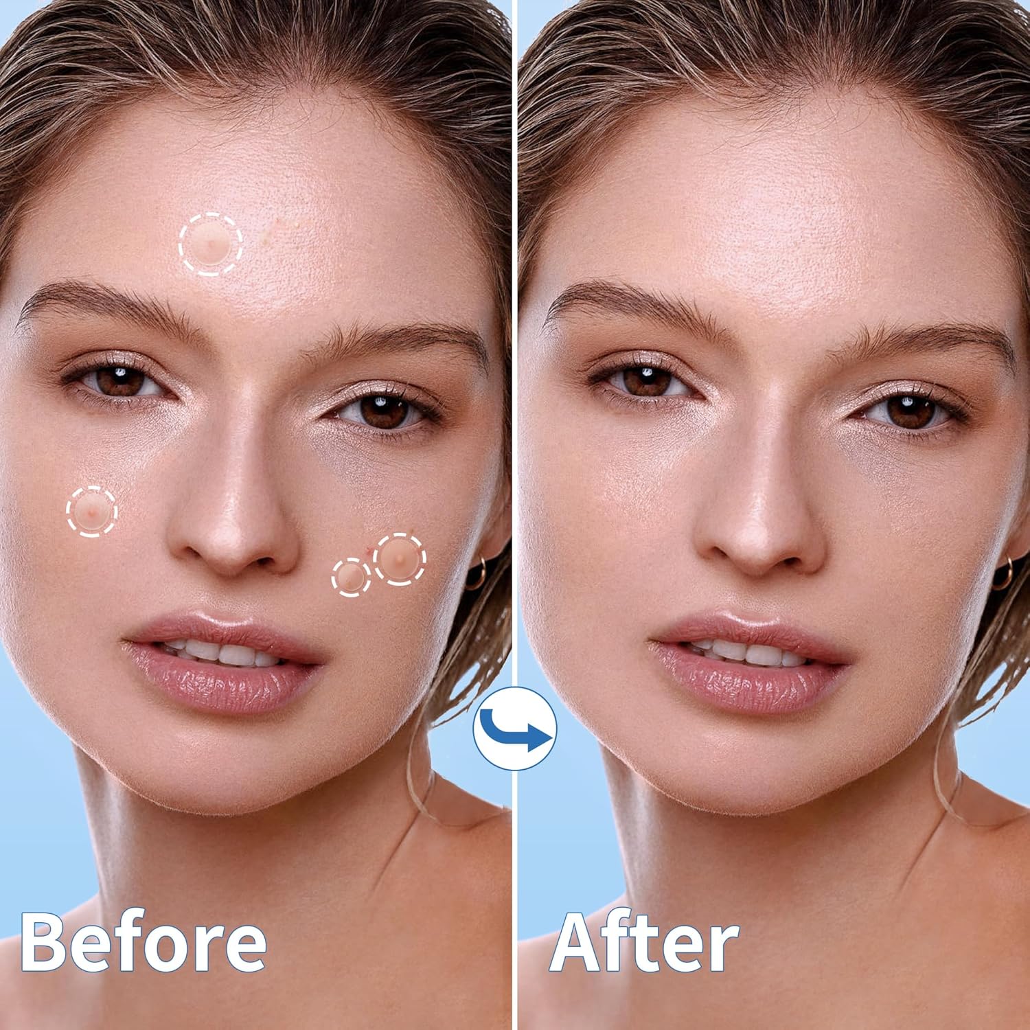 Pimple_Patches_for_Face,_4_Size_300_Counts_Acne_Patches,_Hydrocolloid_Patches_for_Covering_Zits_and_Blemishes,_Spot_Stickers_with_Salicylic_Acid,_Tea_Tree_Oil_&_Calendula_Oil