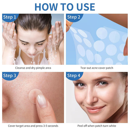 Pimple_Patches_for_Face,_4_Size_300_Counts_Acne_Patches,_Hydrocolloid_Patches_for_Covering_Zits_and_Blemishes,_Spot_Stickers_with_Salicylic_Acid,_Tea_Tree_Oil_&_Calendula_Oil
