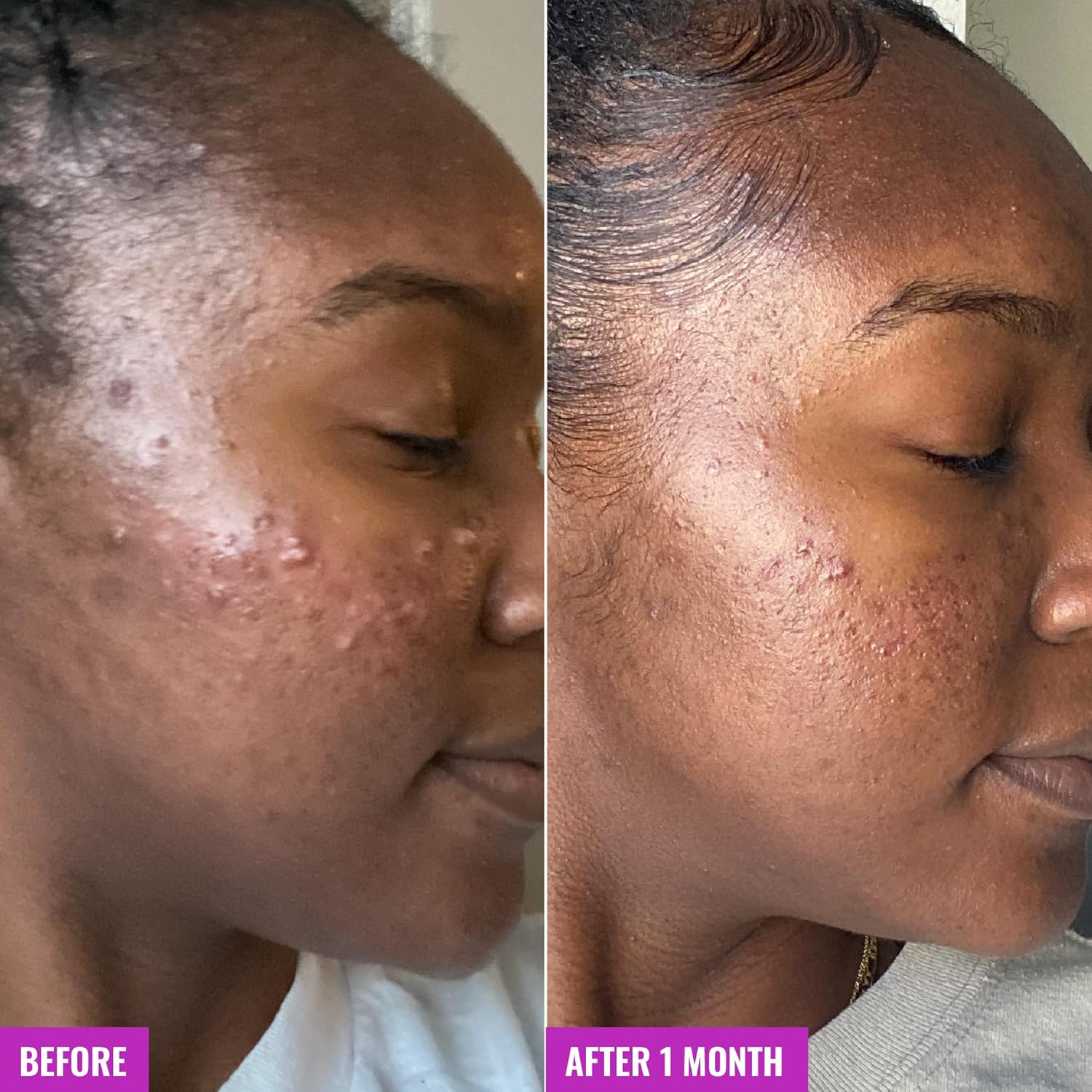 Good_Molecules_Acne_Foaming_Cleanser_-_2%_Salicylic_Acid_Foam_Cleanser_-_Gentle_Acne_Face_Wash_with_Alcohol_Free_Witch_Hazel_and_Aloe_-_Skin_Care_for_Face