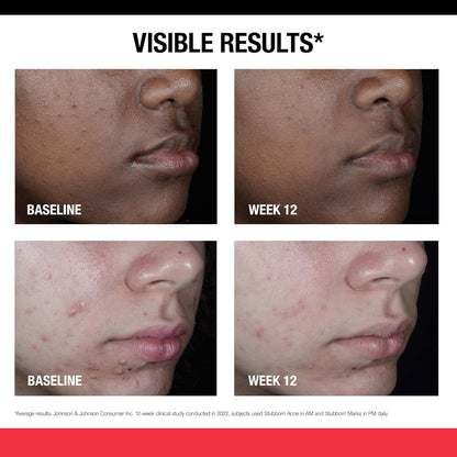 Neutrogena_Retinol_SA,_Stubborn_Marks_PM_Treatment,_Face-Exfoliating_Treatment_to_Help_Reverse_the_Look_of_Post-Acne_Marks_&_Uneven_Skin_Tone,_Non-Comedogenic,_PM_Treatment,_unscented,_1.0_Fl_Oz