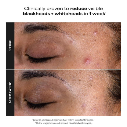 Paula's_Choice_SKIN_PERFECTING_2%_BHA_Liquid_Exfoliant_with_Salicylic_Acid,_Facial_Polish_for_Pores,_Wrinkles_&_Fine_Lines,_Suitable_for_Blackhead-Prone_Skin,_Fragrance-Free