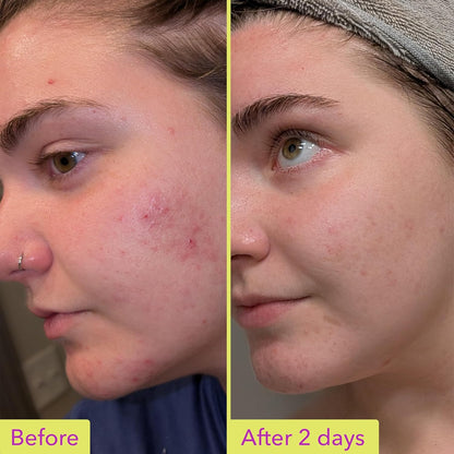 Good_Molecules_10%_Azelaic_Acid_Treatment_for_Face_–_Soothing_Formula_for_Facial_Redness_&_Uneven_Tone_–_Brightens_Dark_Spots_&_Refines_Texture_–_Vegan_&_Fragrance-Free_Skincare_(30ml_/_1.01_fl_oz.)