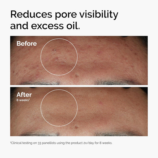 The_Ordinary_Niacinamide_10%_+_Zinc_1%,_Smoothing_Serum_for_Blemish-Prone_Skin