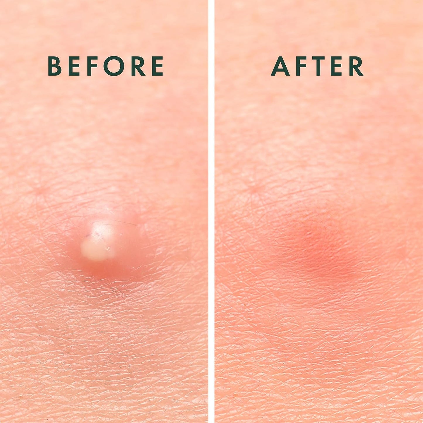 Rael_Miracle_Invisible_Spot_Cover_Hydrocolloid_Acne_Pimple_Patches_(96_Ct)_|_Ultra-Thin_Patch_for_Face,_Absorbs_Fluid_From_Blemishes,_Facial_Sticker,_Korean_Skin_Care,_Pore_Care,_2_Sizes