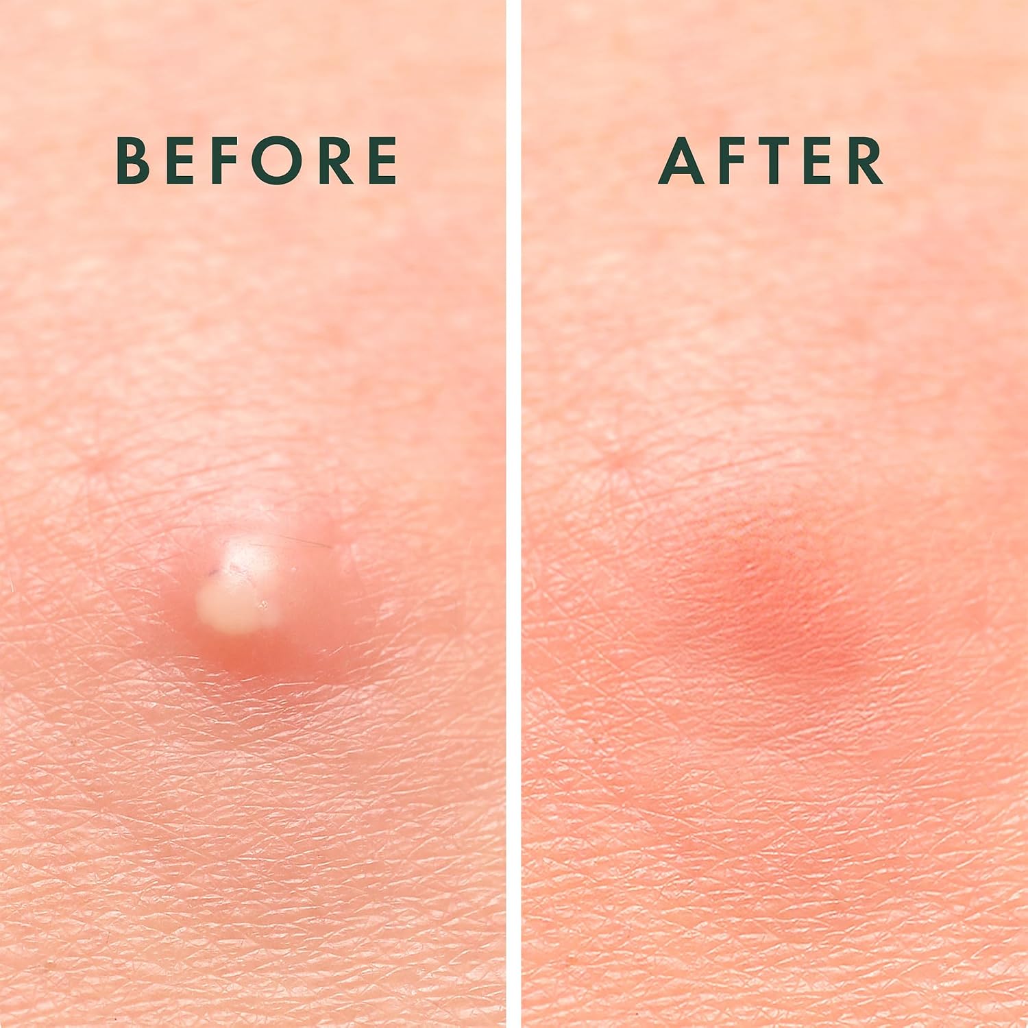 Rael_Miracle_Invisible_Spot_Cover_Hydrocolloid_Acne_Pimple_Patches_(96_Ct)_|_Ultra-Thin_Patch_for_Face,_Absorbs_Fluid_From_Blemishes,_Facial_Sticker,_Korean_Skin_Care,_Pore_Care,_2_Sizes