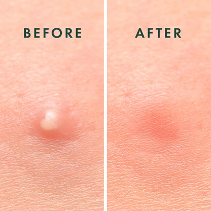Rael_Miracle_Invisible_Spot_Cover_Hydrocolloid_Acne_Pimple_Patches_(96_Ct)_|_Ultra-Thin_Patch_for_Face,_Absorbs_Fluid_From_Blemishes,_Facial_Sticker,_Korean_Skin_Care,_Pore_Care,_2_Sizes
