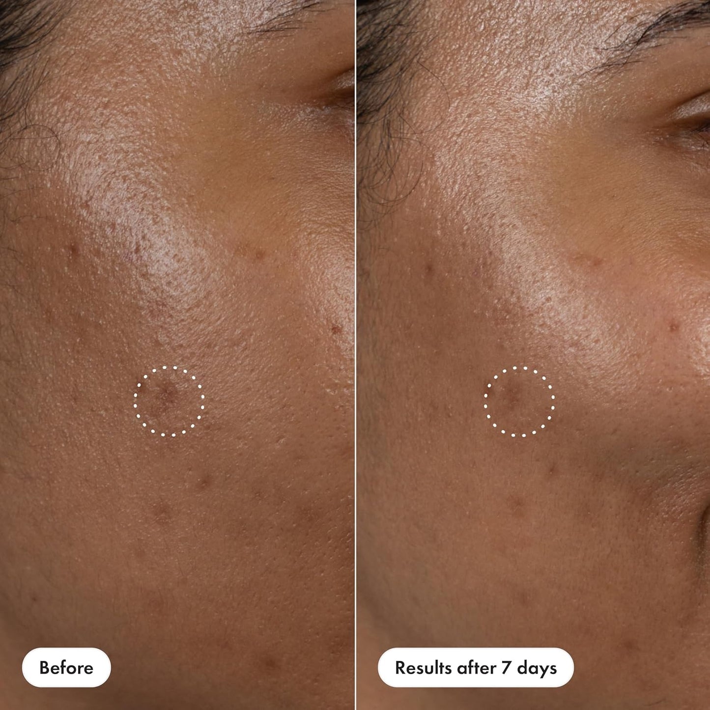 Hero_Cosmetics_Dark_Spot_Correct_Spot-Fading_15%_Vitamin_C_plus_Hyaluronic_Acid_Serum._Improves_the_Look_of_Post_Blemish_Marks_in_7_Days._Twist_Applicator_and_Rollerball_Tip_for_Easy_Application._10mL